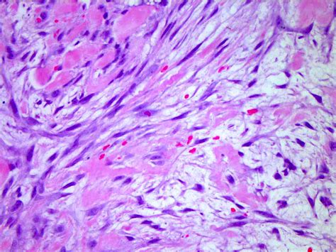 Nodular fasciitis pathology